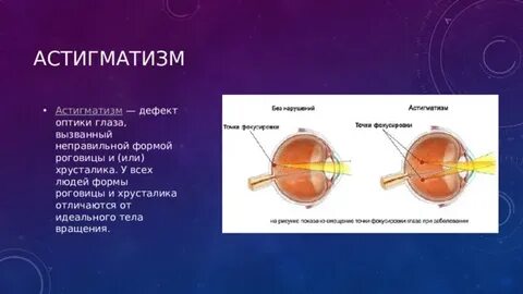 Оптическая система глаза дефекты зрения