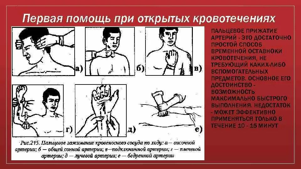 Остановить кровотечение на сонной артерии ответ тест. Кровотечения прижатие артерий. Пальцевое прижатие артерий. Пальцевое прижатие сонной артерии при кровотечении. Временная остановка кровотечений, пальцевое прижатие артерий.