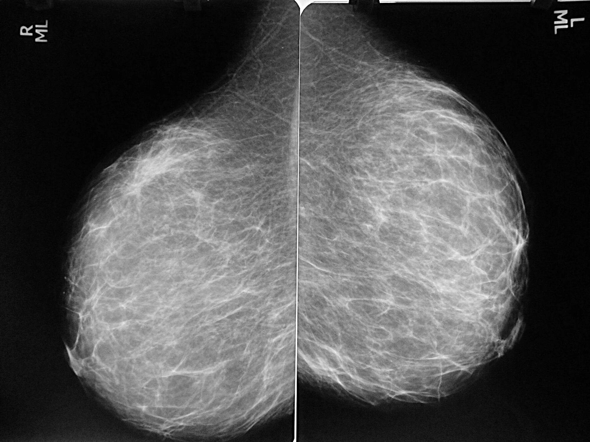 Фото маммографии молочной железы