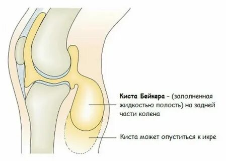 Лечение кисты под микроскопом