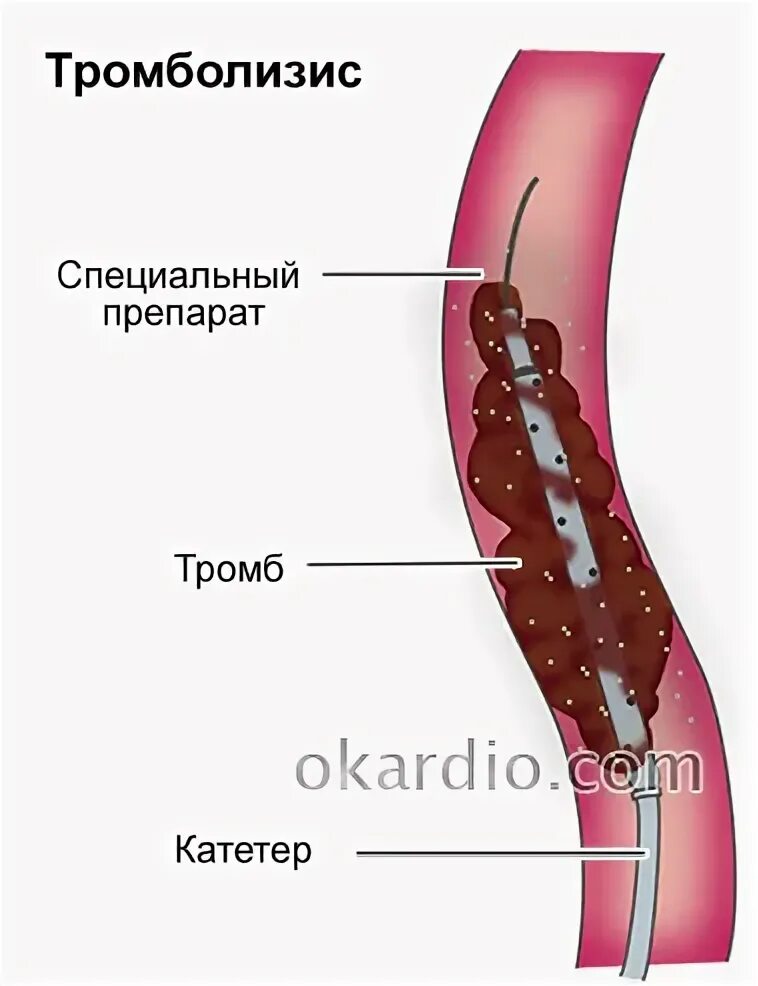 Регионарная тромболитическая терапия. Селективный тромболизис. Регионарный тромболизис. Регионарный катетерный тромболизис.