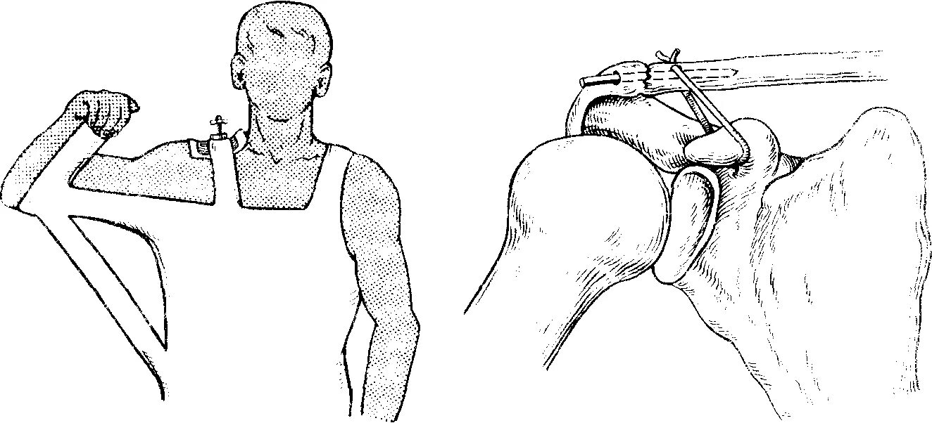 Шина для лечения переломов ключицы. Вывих плечевого сустава вправление. Вывих акс плечевого сустава. Вывих акромиального конца ключицы. Вправление перелома ключицы.