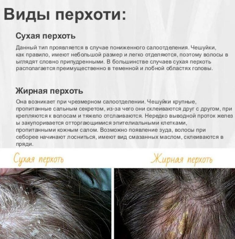Выпадают волосы при мытье головы что делать. Асбестовидный себорейный дерматит. себорейный дерматит трихология. себорейный дерматит сальные железы. себорейный дерматит волосистой части головы.