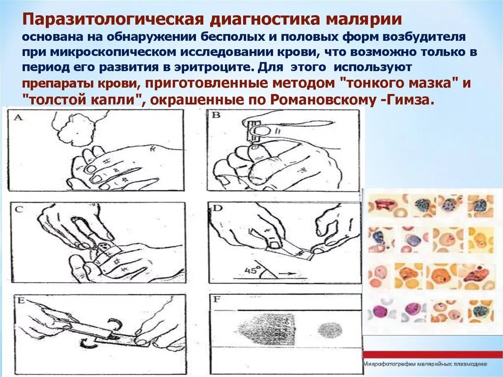 Для диагностики малярии забор крови осуществляют. Метод толстой капли при малярии. Методы лабораторной диагностики малярии. Метод лабораторной диагностики малярии. Взятие толстой капли крови алгоритм.