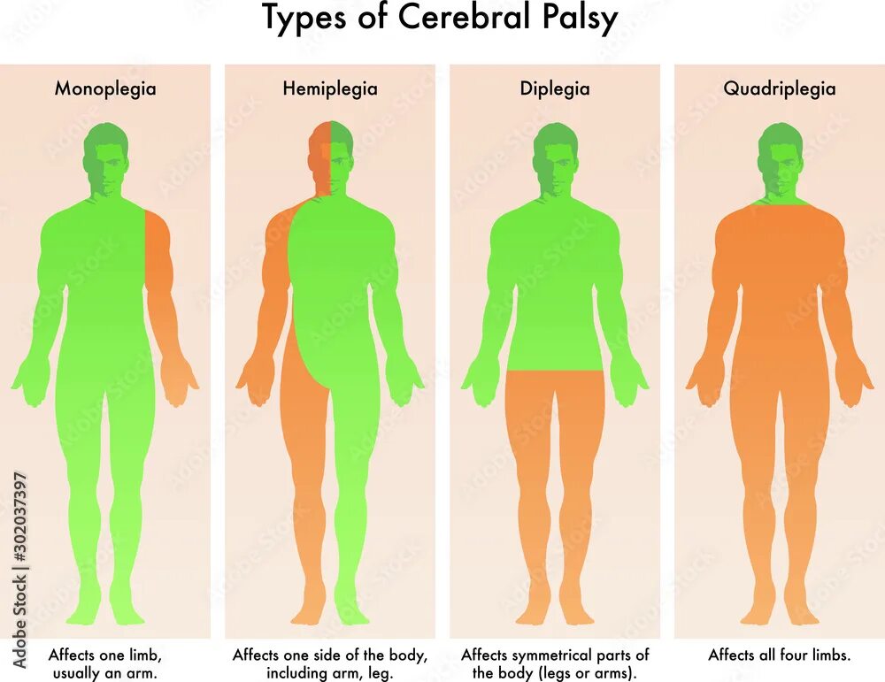 Моноплегия картинки. Двойная гемиплегия. Правосторонняя гемиплегия очаг поражения. Парез и плегия. Правосторонняя гемиплегия.