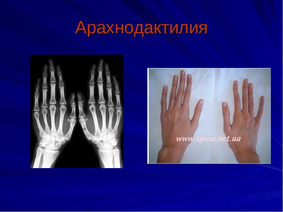 Арахнодактилия паучьи пальцы. Человек смамыми длинными пальцами. Тату паук. Синдром марфана (арахнодактилия). Парное тату паучки.