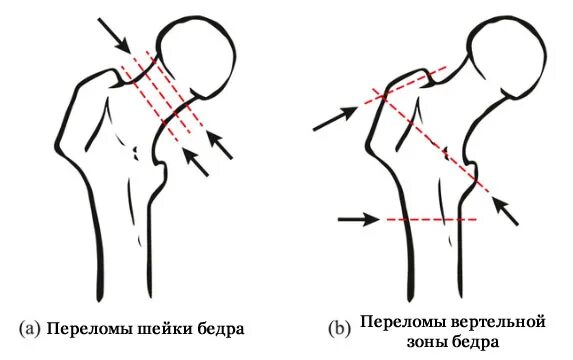 Перелом бедра лечение без операции