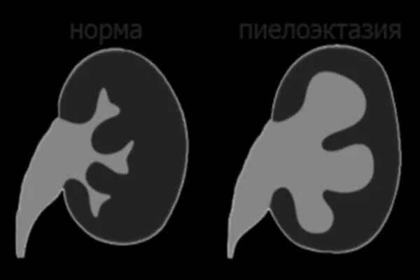 Пиелоэктазия и каликоэктазия. Пиелоэктазия почек мкб 10. Каликопиелоэктазия почки мкб 10 код. Пиелоэктазия код по мкб у детей