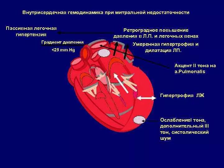 Митральная недостаточность нарушение гемодинамики. Гемодинамика пороков митральная недостаточность. Порок митрального клапана изменения гемодинамики. Гемодинамика при пороках сердца митральный клапан. Сердечная недостаточность митрального клапана