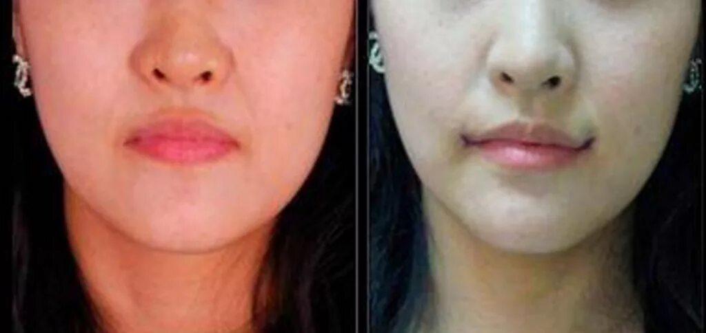 Приподнятые уголки губ. Хейлопластика уголки губ. Идеальная форма губ. Прикрыл губы руками. Женские губы в профиль.