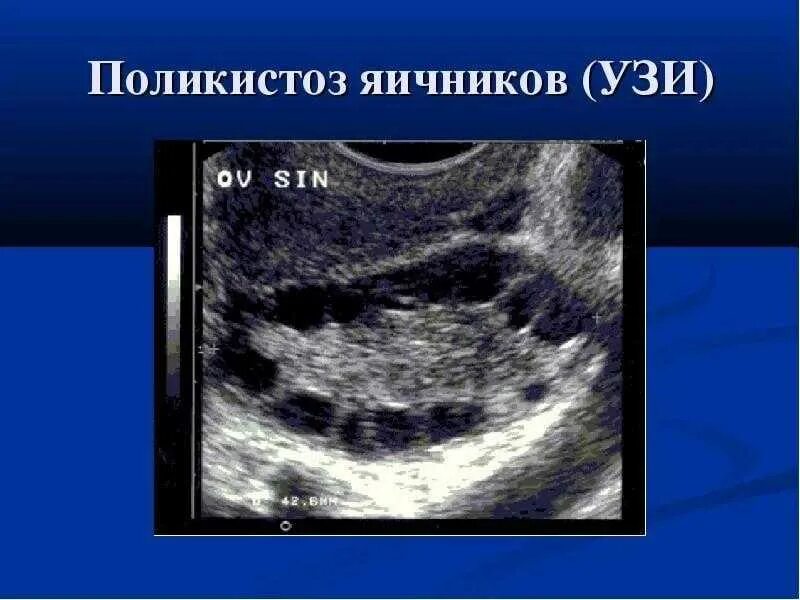 Как выглядит поликистоз яичников. Узи признаки поликистоза яичников. синдром поликистоза яичников на узи. поликистоз яичников снимки узи.