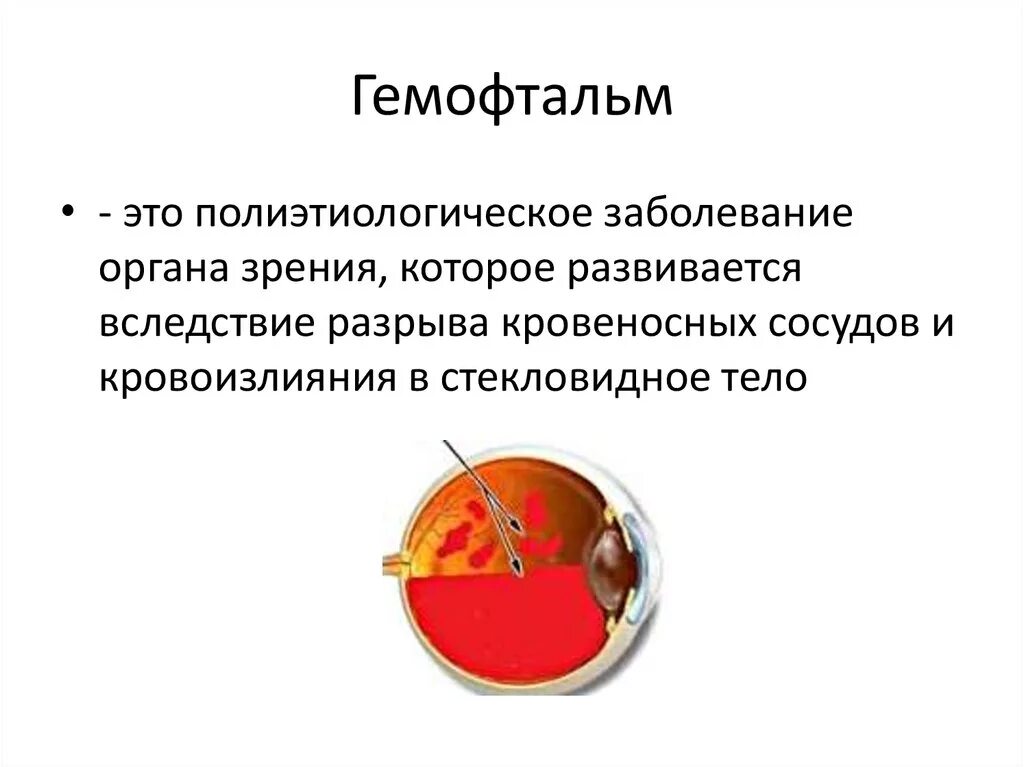 Гемофтальм мкб 10. Кровоизлияние в стекловидное тело (гемофтальм). Субтотальный гемофтальм.