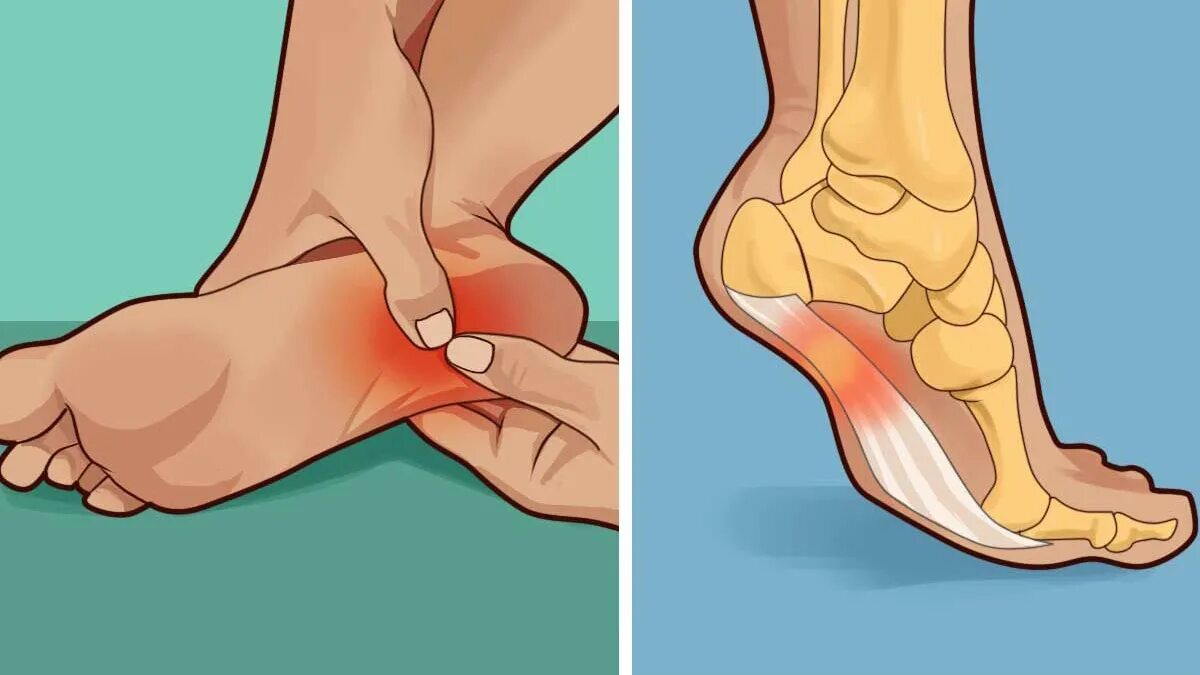 Сильно болят пятки при ходьбе. Плантарный фасциит (подошвенный фасциит). Плантарный фасциит анатомия. Плантарный фасциит триггер.