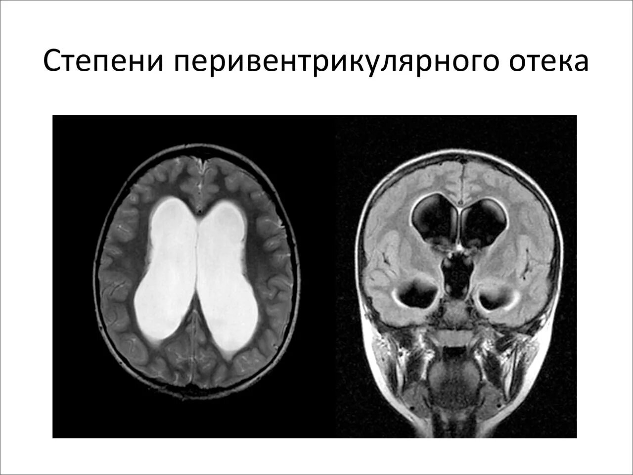 Смешанный гидроцефалия у взрослых. Перивентрикулярный лейкоареоз на кт. перивентрикулярная лейкомаляция кт. перивентрикулярная гидроцефалия.