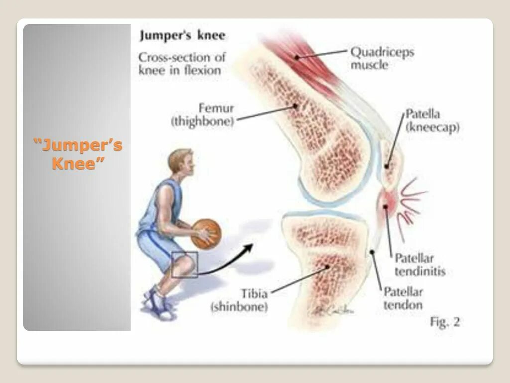 Тендинит сухожилия колена. Тендинит сухожилия надколенника. Тендинопатия сухожилия коленного сустава. Повреждение связки надколенника симптомы. Тендинит коленного сустава что это.