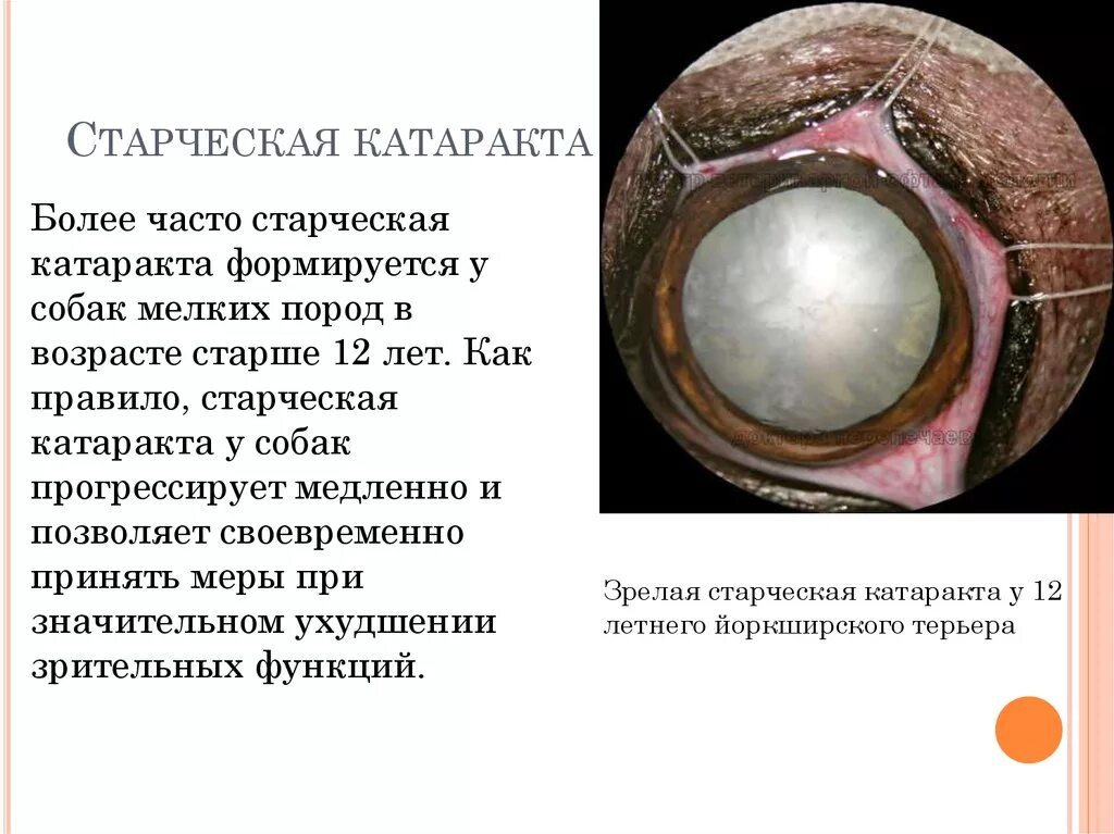 Возрастная катаракта. Старческая морганиева катаракта. незрелая стадия возрастной катаракты. старческая катаракта стадии. старческая ядерная катарактв а.