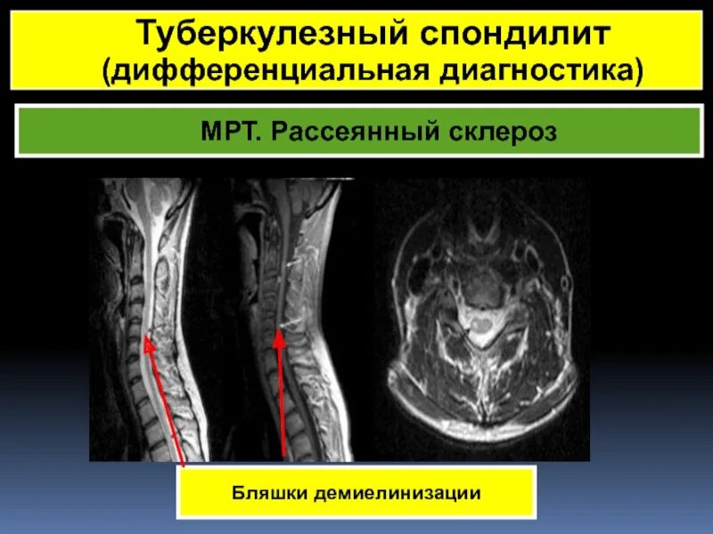 Туберкулезный склероз. Спондилит мрт. спондилит андерсена мрт. спондилит мрт признаки. рассеянный склероз бляшки фото.
