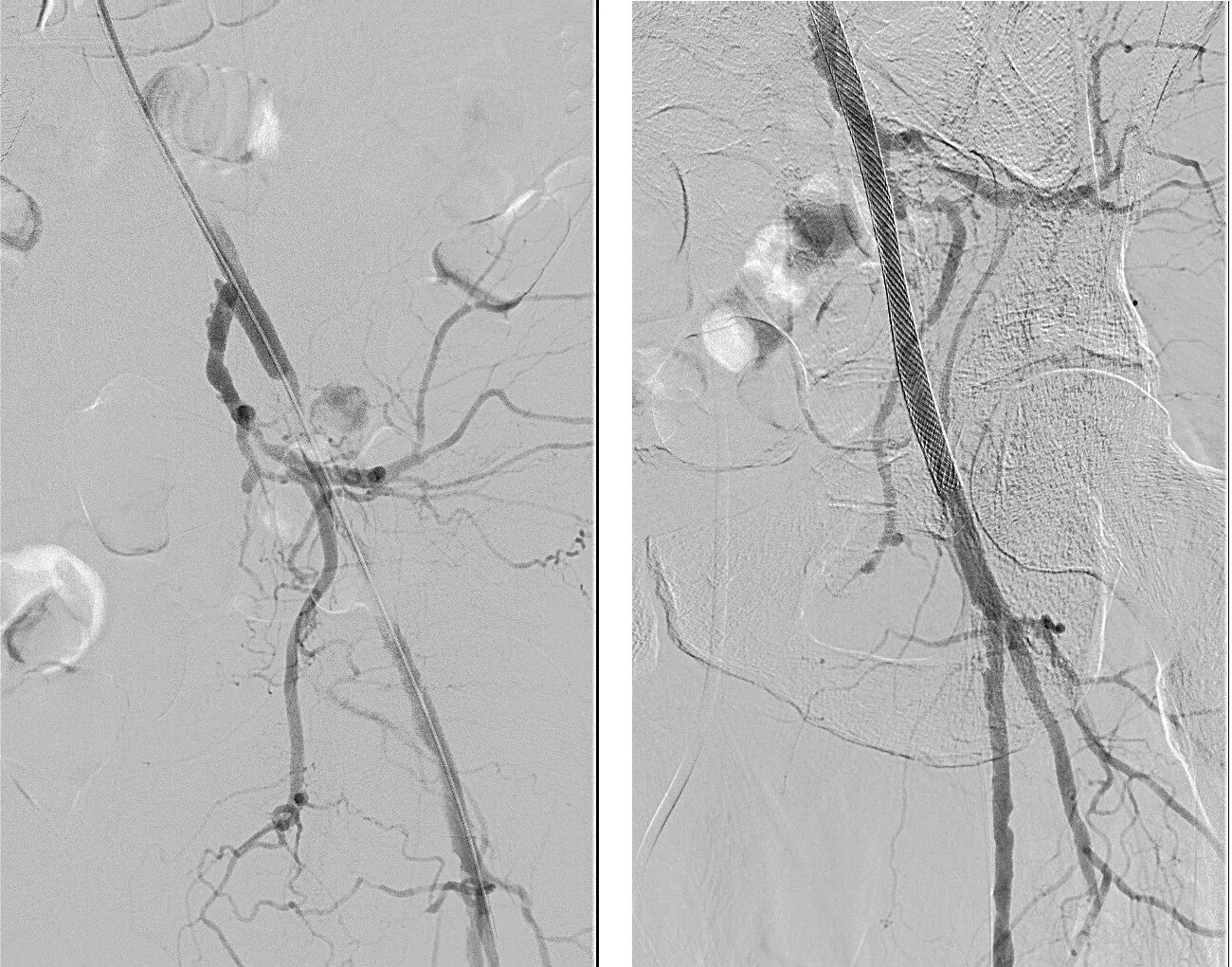 Лекарства после стентирования сосудов. Тензо стентирование. Новейшие стенты для устранения тромбов. Заменитель таблеток брилинта. После стентирования плавикс.