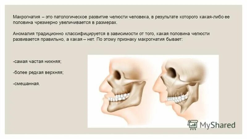 Микрогнатия верхней челюсти (гипоплазия верхней челюсти. Макрогнатия и микрогнатия. Макрогнатия нижней челюсти. Чрезмерно развитая верхняя челюсть. Почему сжата челюсть