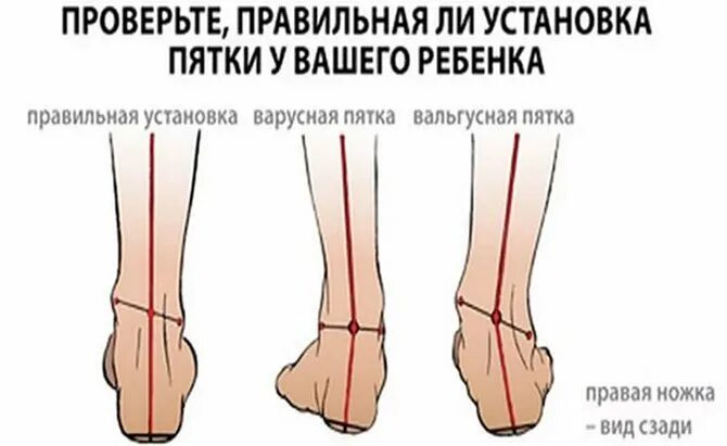 Боль ноги в голеностопном суставе. Вальгусная деформация голеностопного сустава рентген. Вальгусная и варусная деформация стопы. Варусное искривление стопы. Вальгусная деформация щиколотки.