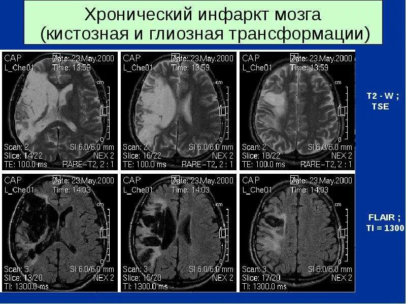 Хронический инфаркт мозга. Глиозные изменения головного мозга на кт. Кистозно-глиозные изменения головного мозга что это.