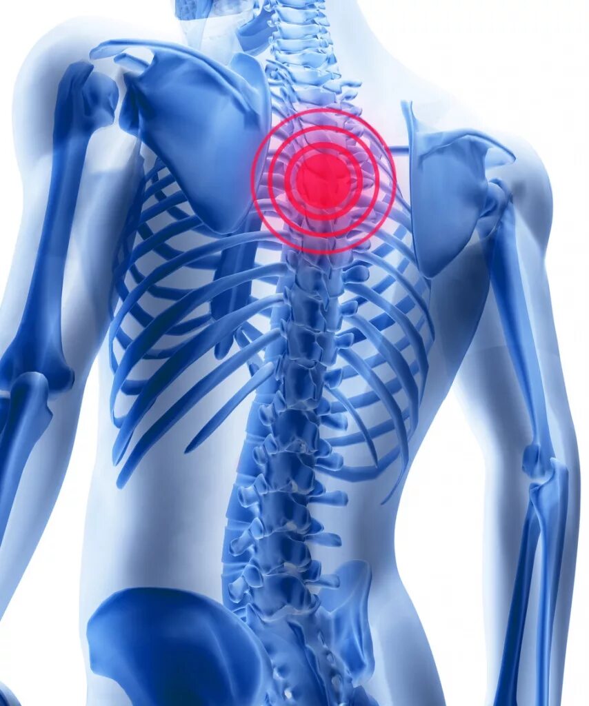 Болит позвоночник между лопатками. Остеохондроз. Грудной остеохондроз. Остеохондроз грудного отдела. Восстановление позвоночника.