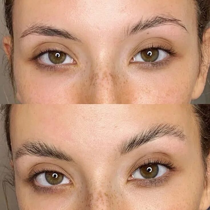 Броулифт. Броу лифт операция броулифт. Brow lifting