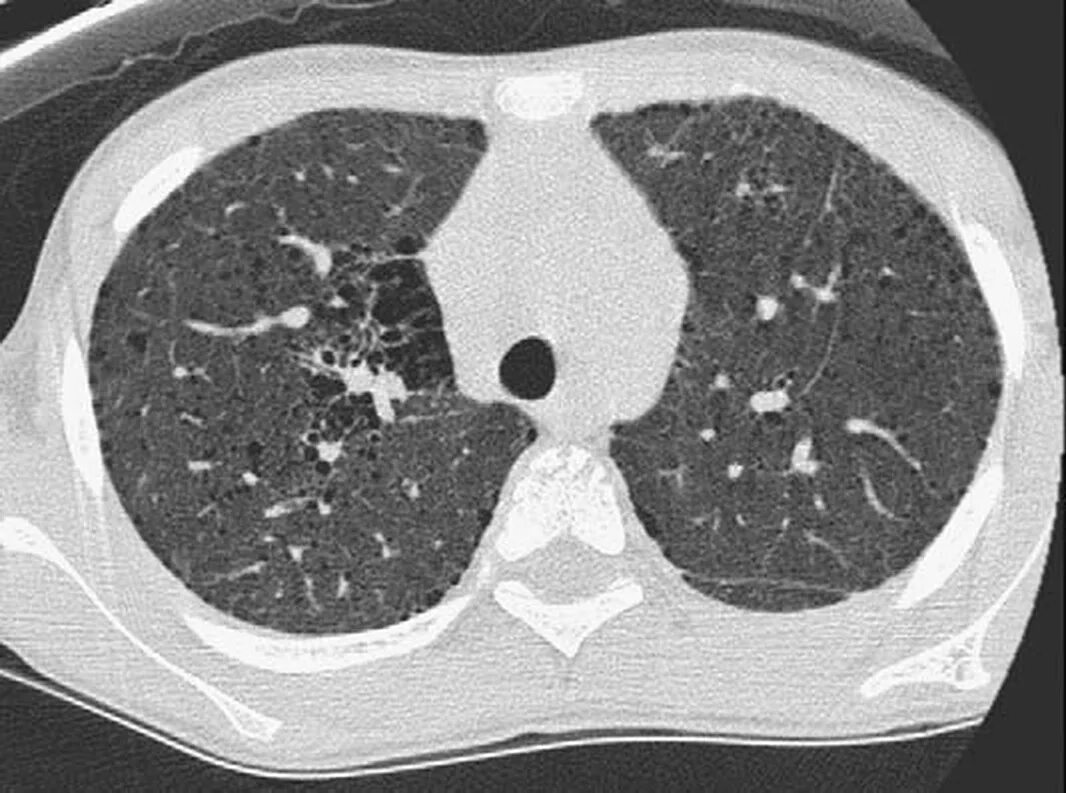 кт легких при хобл. бронхит на кт легких. хронический деформирующий бронхит кт. бронхоэктатическая болезнь легких на кт. бронхит на кт легких.