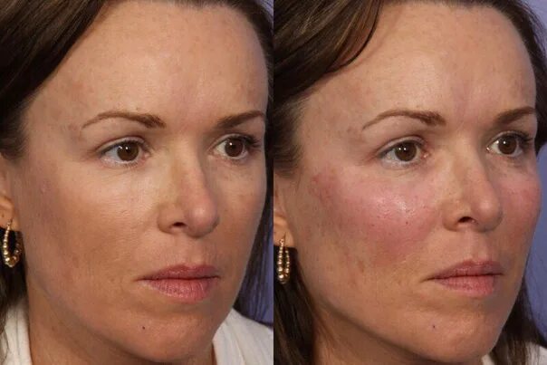 Увеличение скул до и после женщины Pin by Marina Vujovic on beautys Skin and hair clinic, Cheek fillers, Facial fil