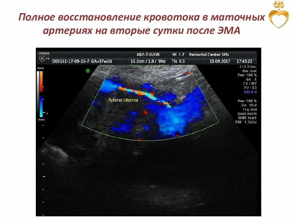 Повышен маточный кровоток. Нарушение кровотока в маточных артериях при беременности. нарушение кровотока в правой маточной артерии при беременности. кровоток в маточных артериях нарушен.