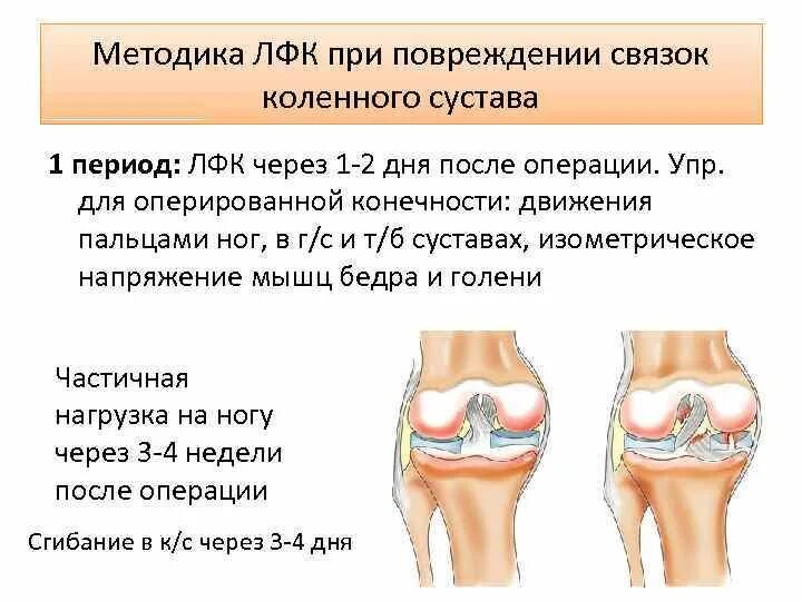 Лечебная физкультура при разрыве связок коленного сустава. ЛФК после травмы коленного сустава. ЛФК для разработки коленного сустава. ЛФК после травмы связок коленного сустава. Время восстановления коленного сустава