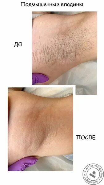 Чем отличается бикини от тотального бикини. Депиляция глубокое бикини. зона классического бикини. бикини классическое это какая зона эпиляции. шугаринг глубокое бикини.