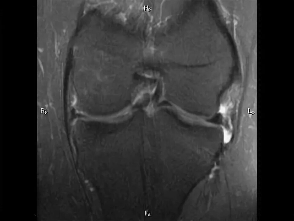 Разрыв мениска по типу ручка лейки на мрт. Разрыв медиального мениска по типу ручки лейки мрт. Разрыв мениска ручка лейки мрт. Повреждение мениска по типу ручки лейки мрт.