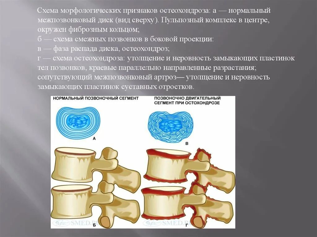 1 признаки остеохондроза