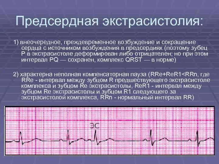 Атриовентрикулярная аритмия ЭКГ. Предсердная аритмия на ЭКГ. ЭКГ при атриовентрикулярном ритме. Предсердная экстрасистолия аритмия ЭКГ. Экстрасистолы лежа