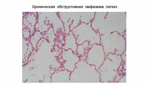 Хроническая эмфизема