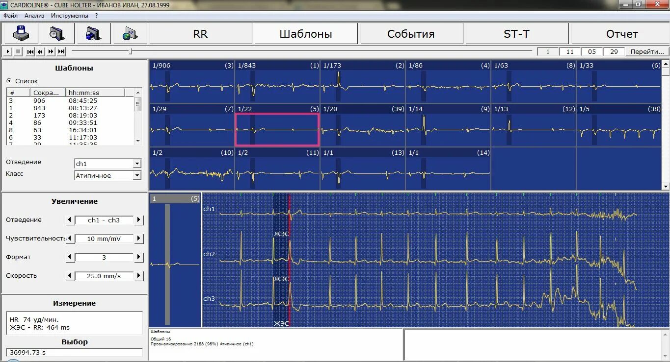 Система телеметрического мониторинга электрокардиограммы. Программа для анализа ЭКГ. Программа Холтер. Суточный мониторинг ЭКГ.