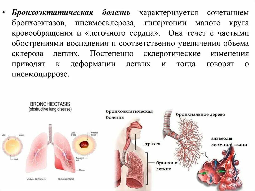 Бронхоэктатическая астма