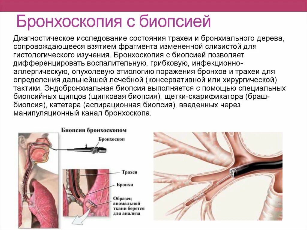 Бронхоскопия с браш биопсией. Бронхоскопия с биопсией легкого. Бронхоскопия это исследование.