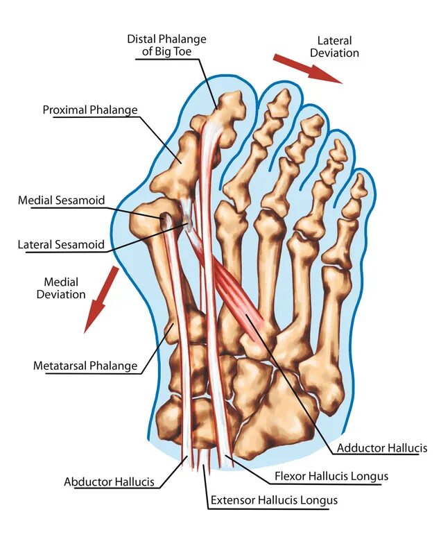 1 Плюснефаланговый сустав стопы. Патогенез халюс вальгус. Hallux valgus 1 плюснефалангового сустава. Стопа сустав вальгусная деформация 1 пальца. Отводящий большой палец стопы