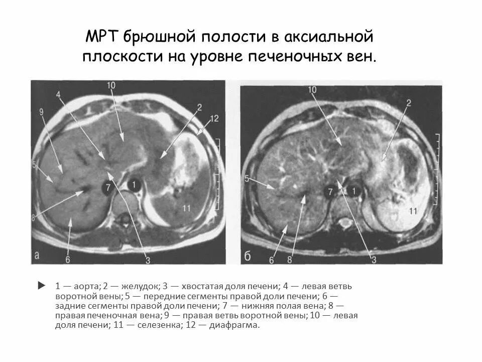 Тромбоз брюшной. Аксиальный срез брюшной полости. Аксиальная проекция брюшной полости. Кт брюшной полости аксиальный срез. Кт анатомия брюшной полости на корональном срезе.