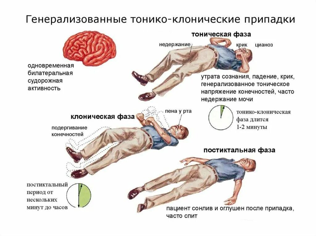 Как начинается приступ эпилепсии. Признаки эпилептического припадка. генерализованными тонико-клоническими припадками. генерализованные тонико-клонические судороги. клонические приступы эпилепсии.