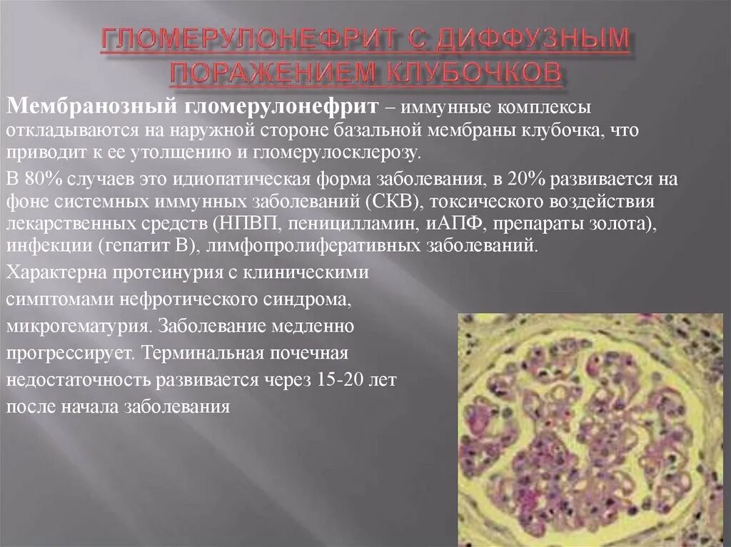 Мембранозный пролиферативный гломерулонефрит. Мембранозный гломерулонефрит микроскопия. Хронический мембранозный гломерулонефрит. Диффузный мембранозный гломерулонефрит. Хронический диффузный гломерулонефрит