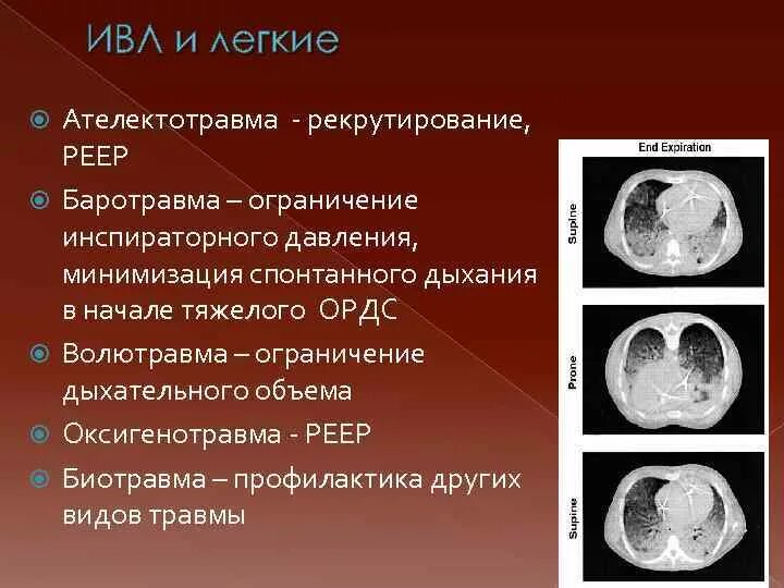 Ателектотравма ИВЛ. Баротравма это простыми словами в медицине