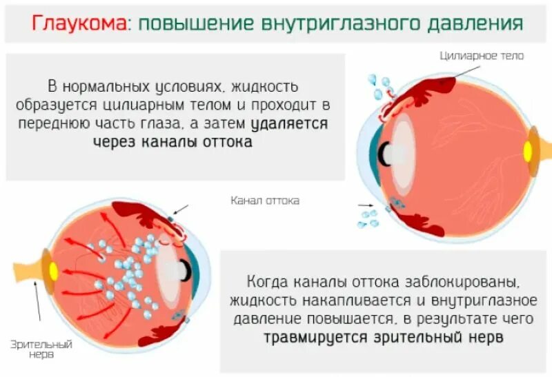 Глаукома глаза причины. Повышенное внутриглазное давление. Повышение внутриглазного давления. Внутре глазное давление. Повышение ВГД главкома.