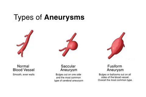 Aneurysm перевод