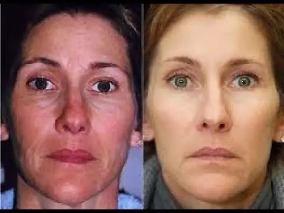 Clear + Brilliant Results, Female #results #skincare #arlington Arlington, Plast