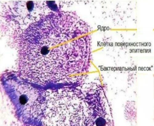 Гарднерелла ключевые клетки. Баквагиноз ключевые клетки. Ключевые клетки при бактериальном вагинозе. Ключевые клетки при вагинозе. Баквагиноз что это