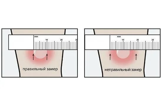 Манту размеры норма у детей 7. Положительный тест манту.