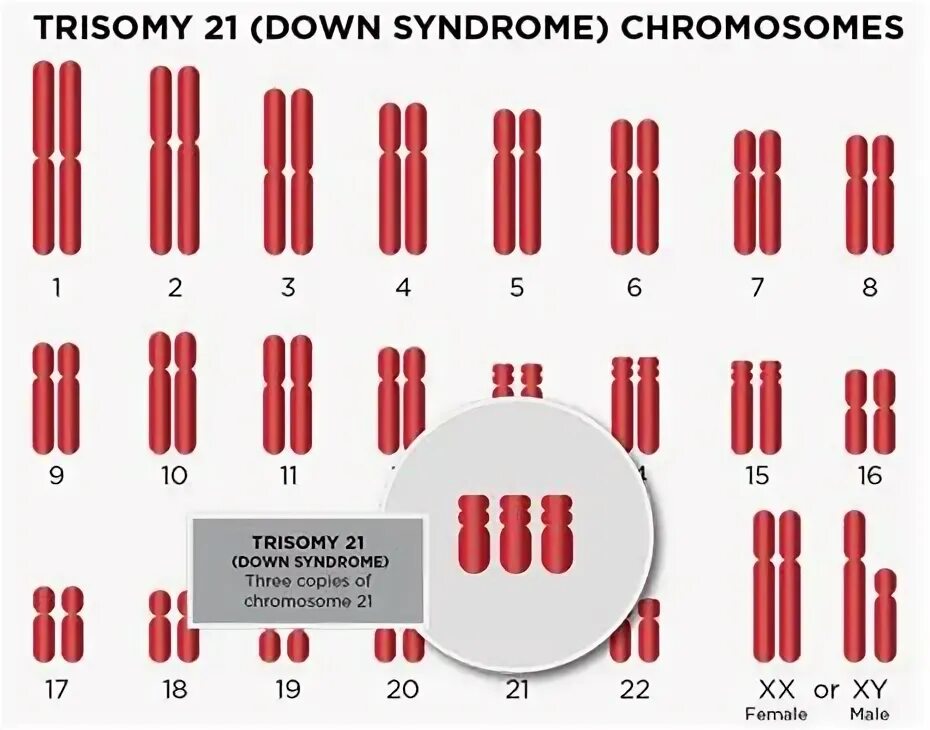 21 Хромосома. 10 Хромосома. Робертсоновская транслокация 21 хромосомы кариотип. Лишняя 21 хромосома